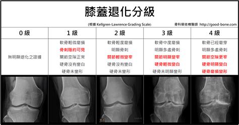 膝蓋長毛怎麼辦|膝蓋關節退化有4階段 骨科醫：出現這些徵兆千萬別。